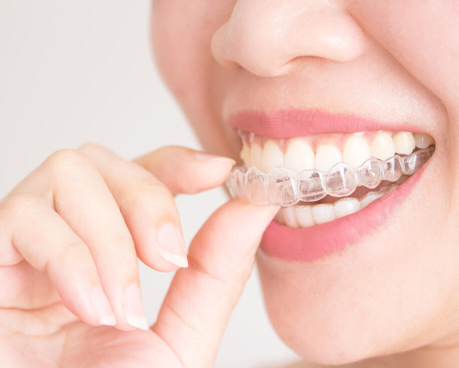 aligneurs dentaires transparents pour correction de l’alignement des dents